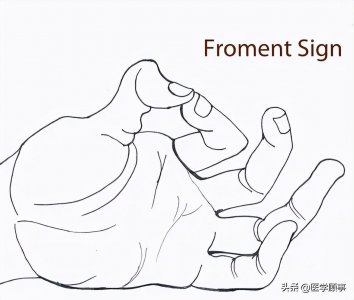 ​什么是froment征