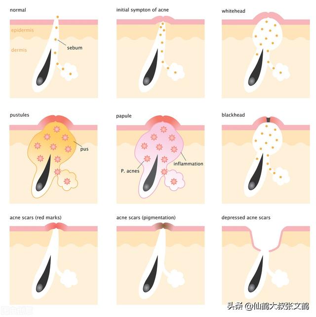 深度去黑头的好方法（各种去黑头偏方真的有效吗）(1)