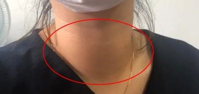 ​女子甲亢十年，一直吃“药”却不见好转，脖子却越来越粗了！