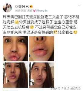 ​亚美只只昨天打完破尿酸今天嘴巴成香肠，网友：可以用针扎吗？