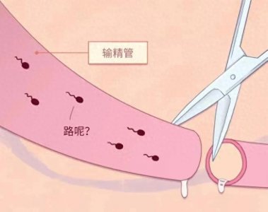 ​那些结扎的男人们，后来都怎么样了？